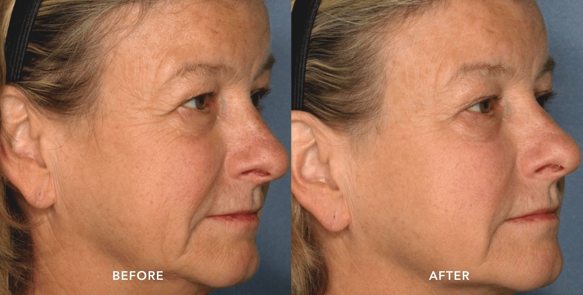 PicoSure-before-and-after-treatment