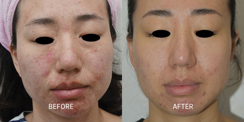 Potenza-Microneedling-Before-and-After-1