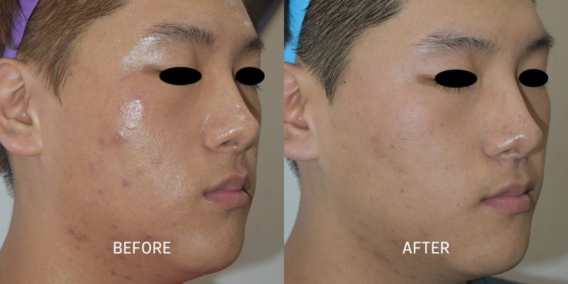 Potenza-Microneedling-Before-and-After-2