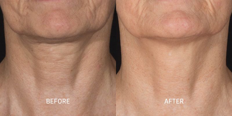 Potenza-Microneedling-Before-and-After-6